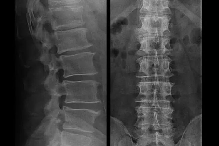 osteokondrosia X izpietan