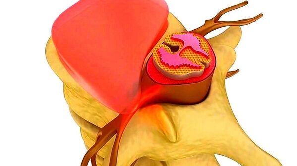 Bizkarrezurreko torakoaren osteokondrosia gaixotasunaren esentzia